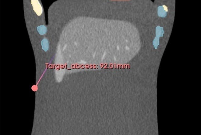 PERCISIO Advanced Abscess Treatment