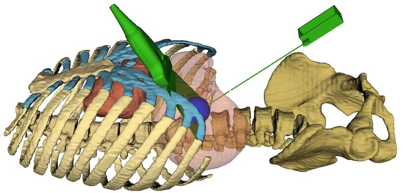 PERCISIO Needle Guidance Procedure