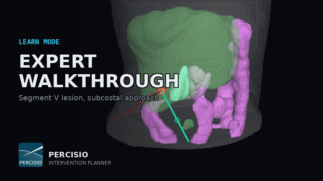 Expert Walkthrough — Segment V Lesion, Subcostal Approach