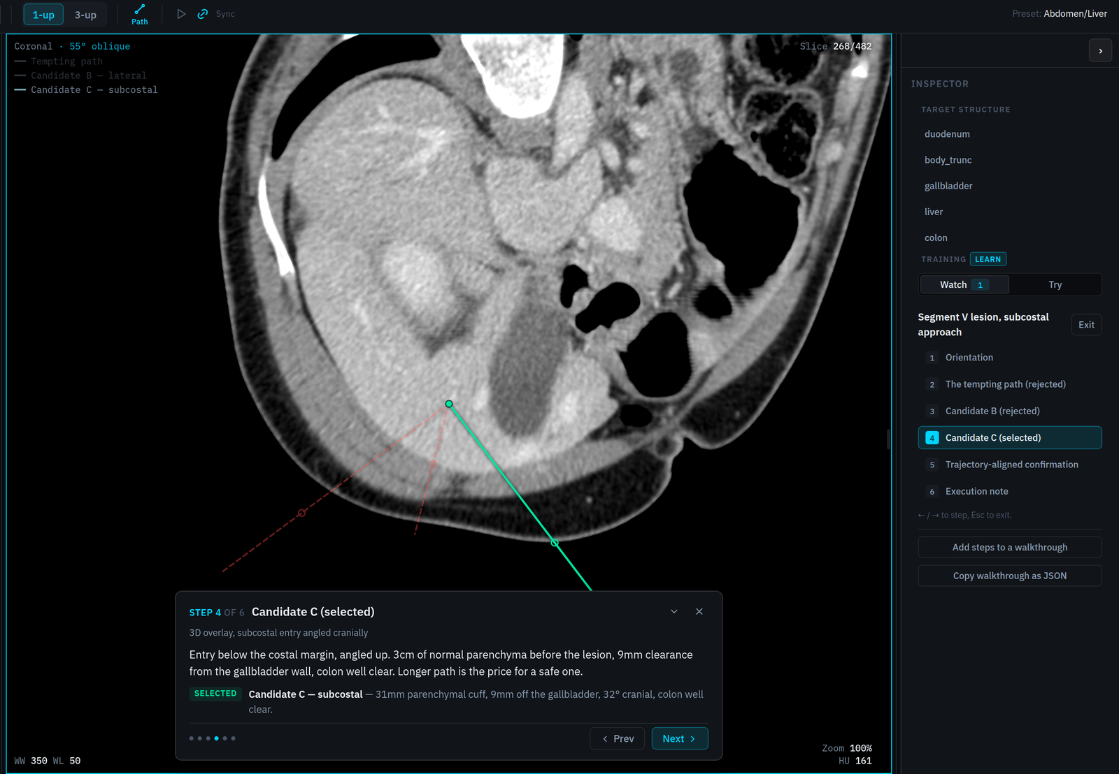 Learn mode in Percisio Intervention Planner: the selected subcostal path drawn solid on an obliquely recut CT, the rejected candidates dashed, with the operator's narration beside them.